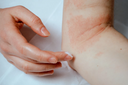 Les vertus de l'encens contre l'eczéma