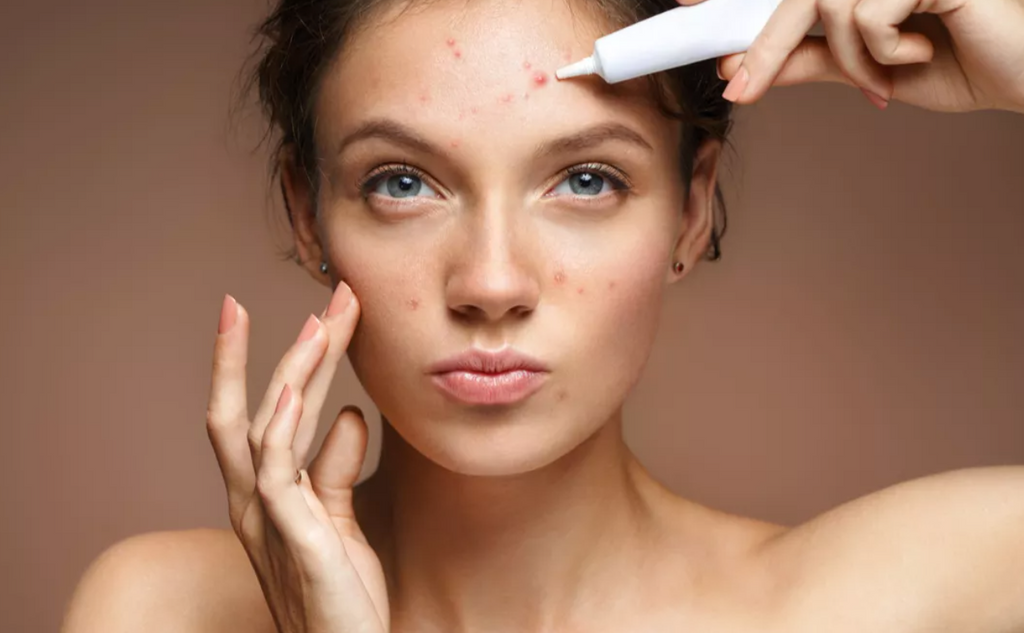 Les ingrédients naturels les plus efficaces pour lutter contre l'acné