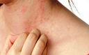 Eczéma et psoriasis sur le cou