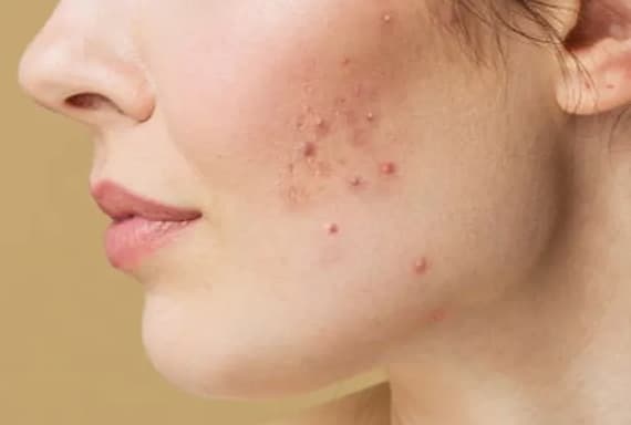 Femme avec acné hormonale