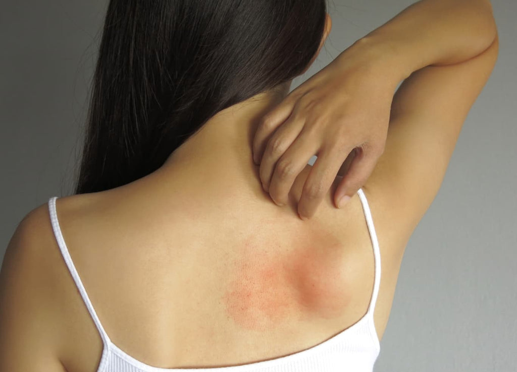 Mycose et Eczéma