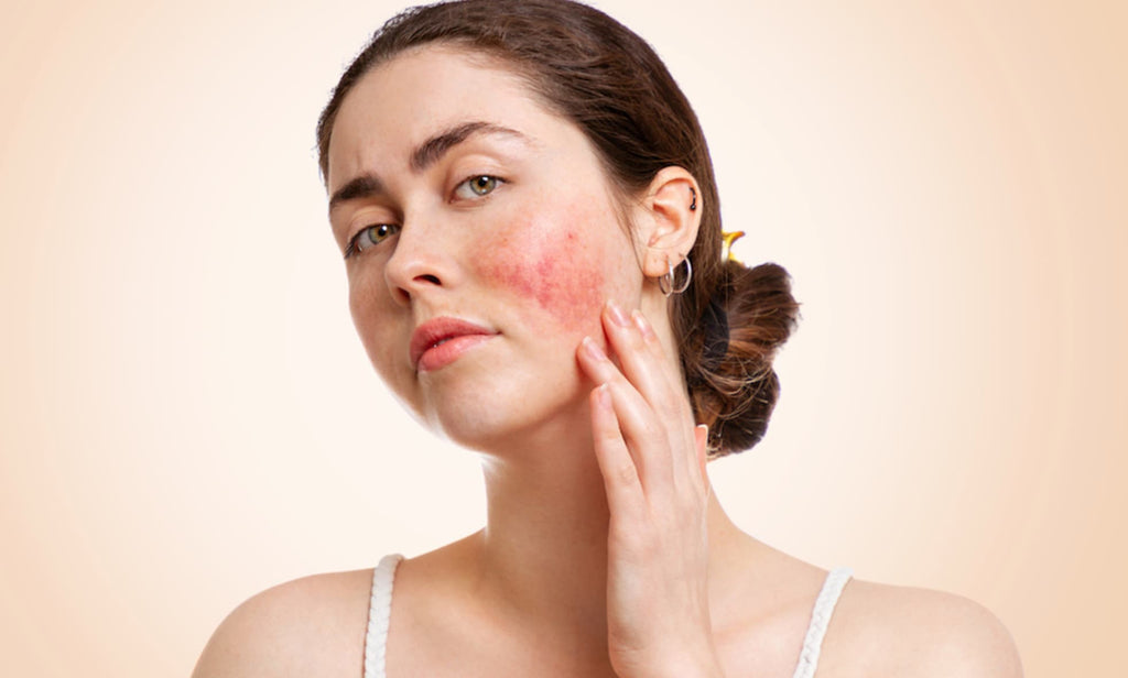 Rosacée sur le visage