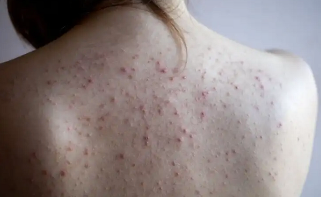 Femme avec des pétéchies sur le dos 