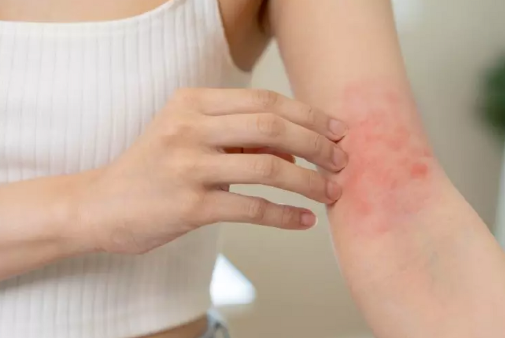 femme avec des rougeurs sur l'avant bras